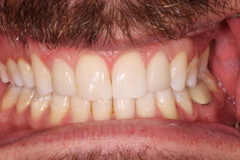 Clinical view of brightened, well-aligned upper and lower teeth following professional teeth whitening and reshaping.