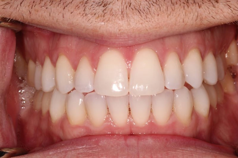 Clinical Retractor view showing symmetrical, white, and balanced dental arches after cosmetic reconstruction.