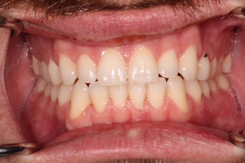Clinical view showing straight, evenly proportioned lower teeth after alignment and restoration.