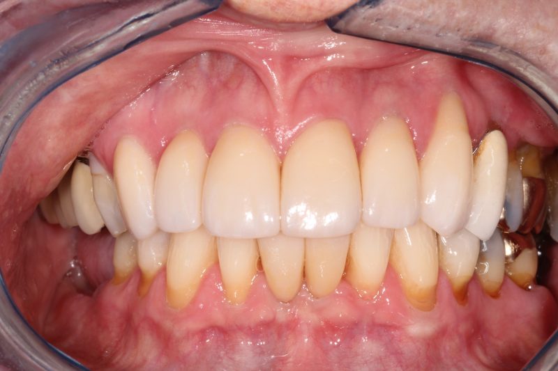 Clinical view of restored gum line and a full bridge of clean, healthy teeth after periodontal and prosthetic care.