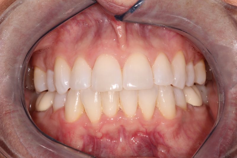 Clinical view of corrected bite relation with bright, uniform teeth after full arch rehabilitation.