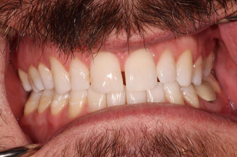 Clinical view of natural teeth showing mild yellowing and slight gap before whitening and cosmetic treatment.