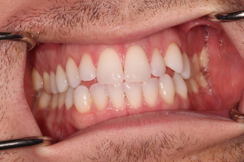 etractor view showing misaligned bite and uneven tooth wear before full arch restoration.