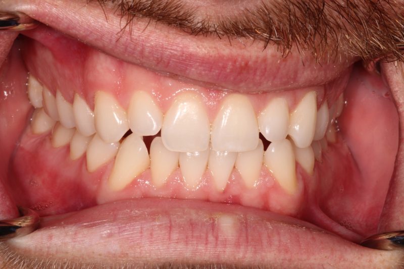 Clinical view showing lower anterior crowding and uneven spacing before dental alignment treatment.