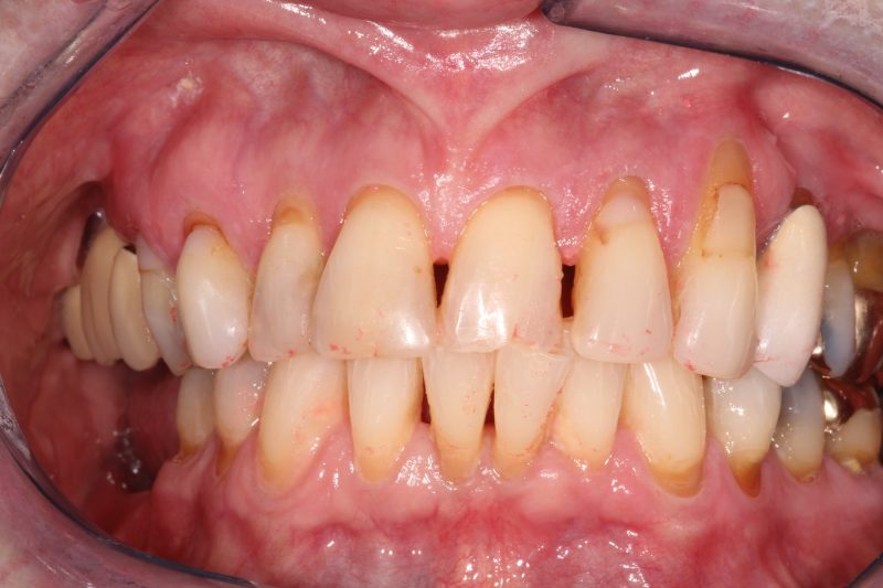 Clinical view of advanced periodontal recession, exposed tooth roots, and tooth spacing before reconstructive care.