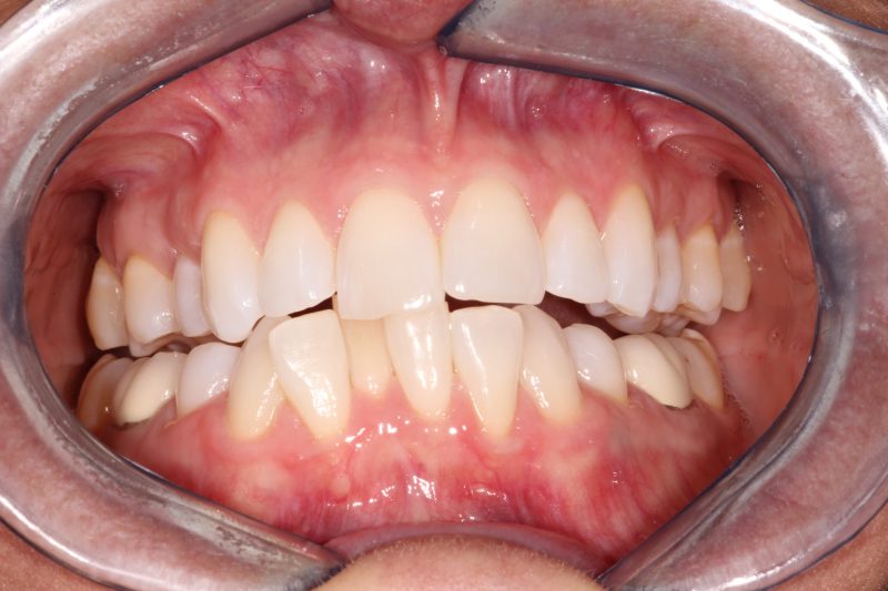 Clinical view of a deep bite and crowded upper arch before restorative dentistry.