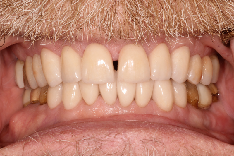 Close-up of restored upper and lower teeth with natural coloration and improved spacing after treatment.