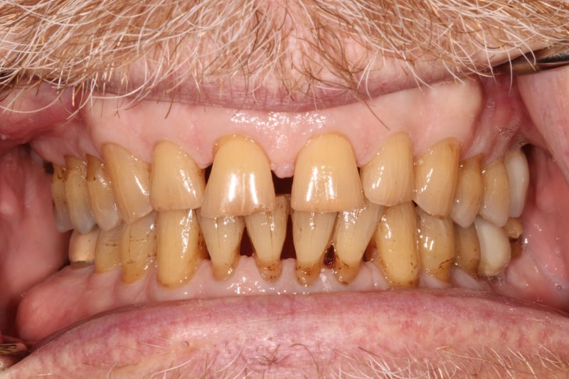 Close-up showing severely yellowed, stained, and spaced natural teeth prior to restorative dental work