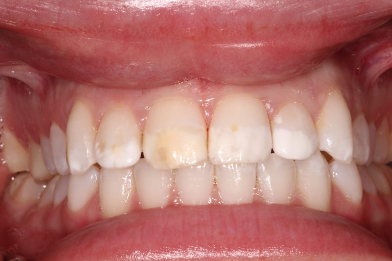Close-up of natural upper and lower teeth displaying minor misalignment and color unevenness.
