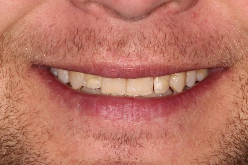 Close-up smile of a male patient showing worn and slightly uneven teeth before cosmetic dental procedures.