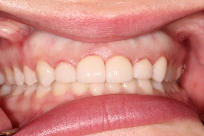 Close-up of closed gaps and aligned front teeth after dental bonding or porcelain veneer placement.