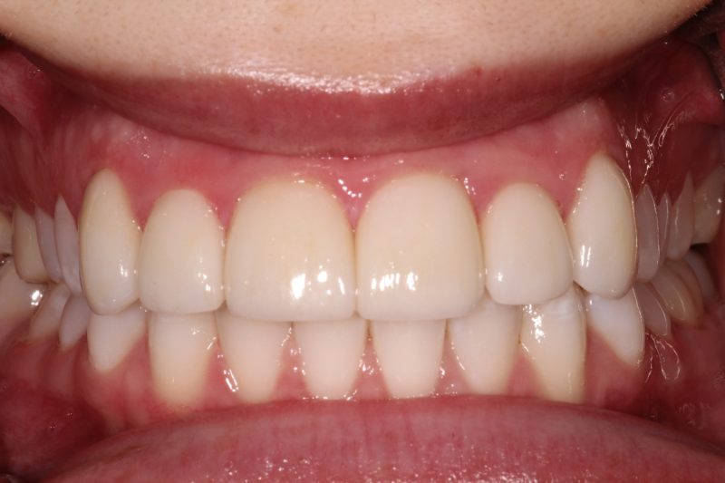 Close-up view of bright white, perfectly aligned dental crowns showing a uniform bite.