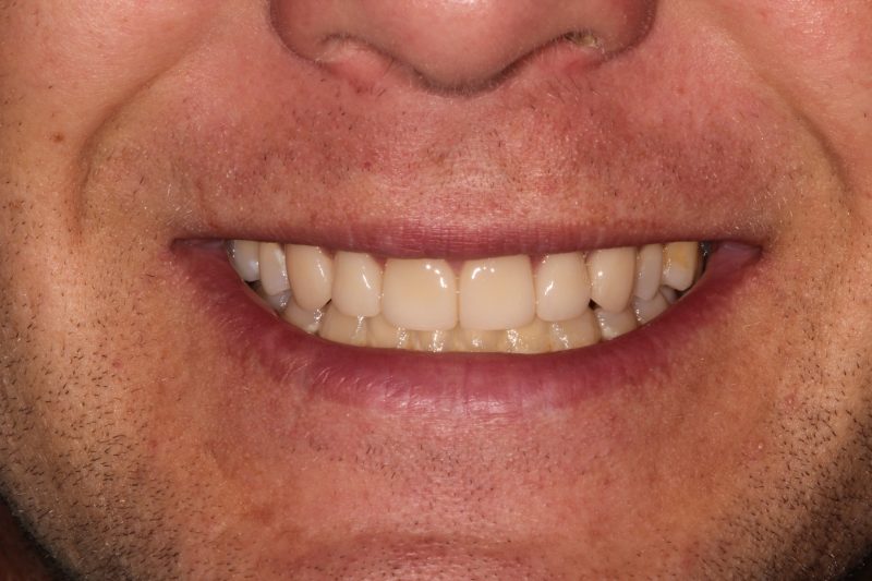 Close-up smile of a male patient with bright, straight, and fully restored cosmetic veneers.