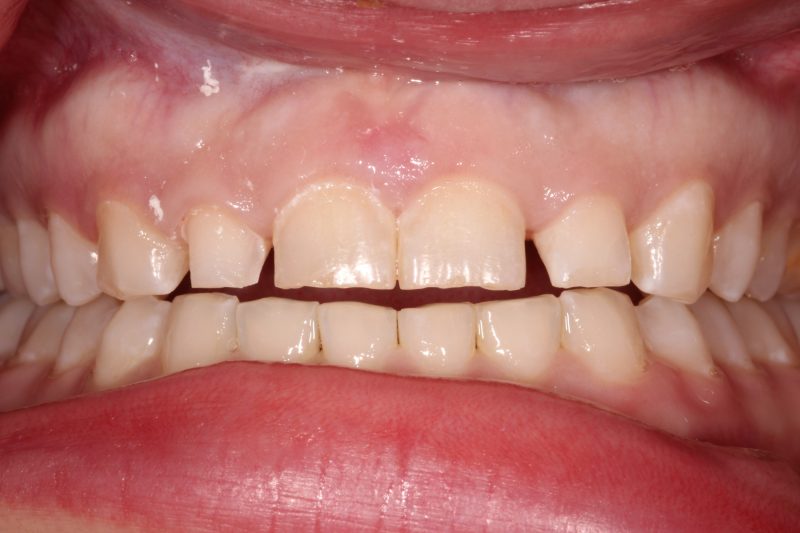 Close-up of natural front teeth with visible gaps and spacing issues before orthodontic or cosmetic treatment.